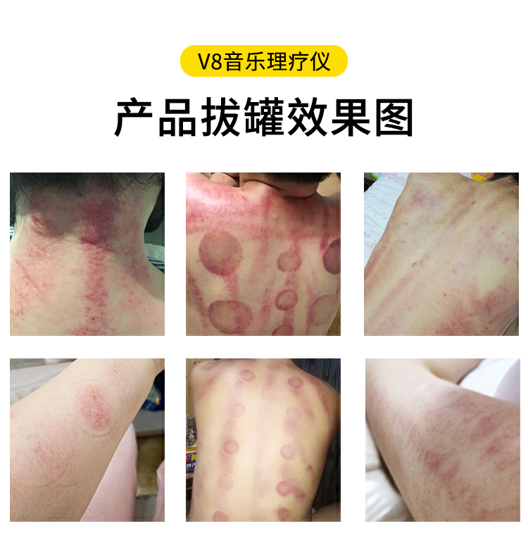 V8音樂(lè)理療儀拔罐效果圖